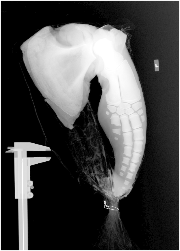 Ein Röntgenbild eines menschlichen Beins mit einem sichtbaren Bruch in der Mitte, vor schwarzem Hintergrund, das eine Bänderverletzung zeigt.