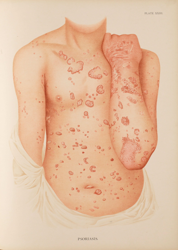 Buchumschlag mit einer Illustration eines Mannes, dessen Oberkörper mit roten Flecken bedeckt ist, die wahrscheinlich Psoriasis darstellen, und Text, der Informationen zum Zustand liefert.